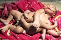 В Индии новорожденного с парой лишних рук и ног на животе приняли за божественного ребенка
